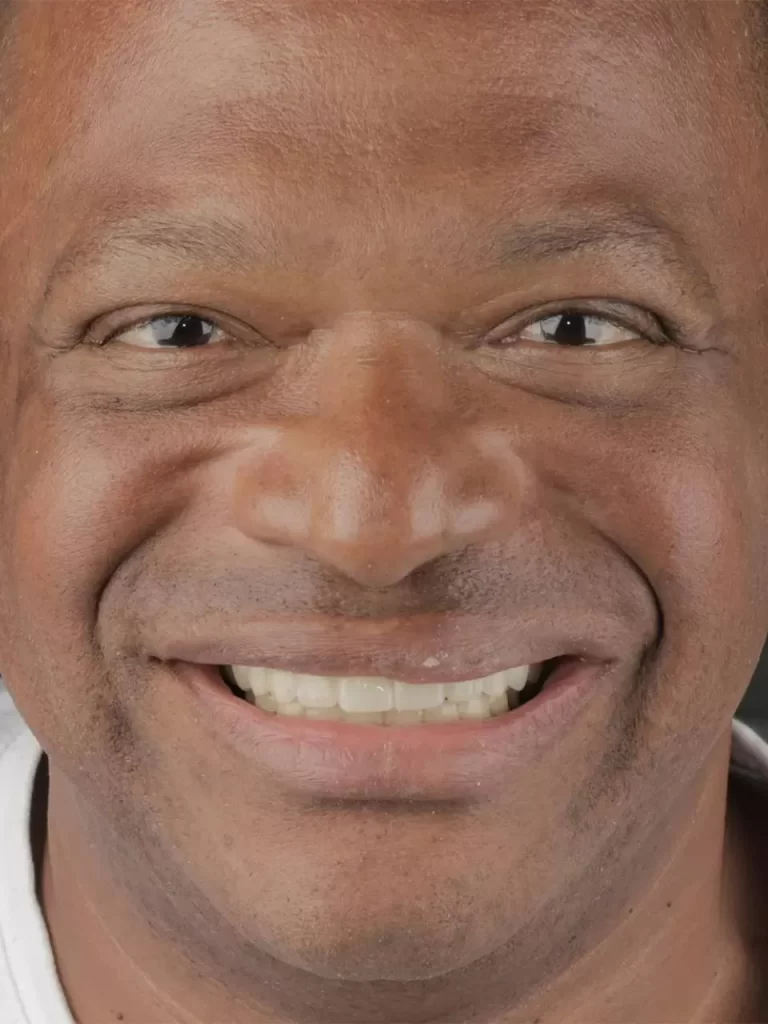 pacientes dr jenival junior dentista de implante prótese em Itabuna